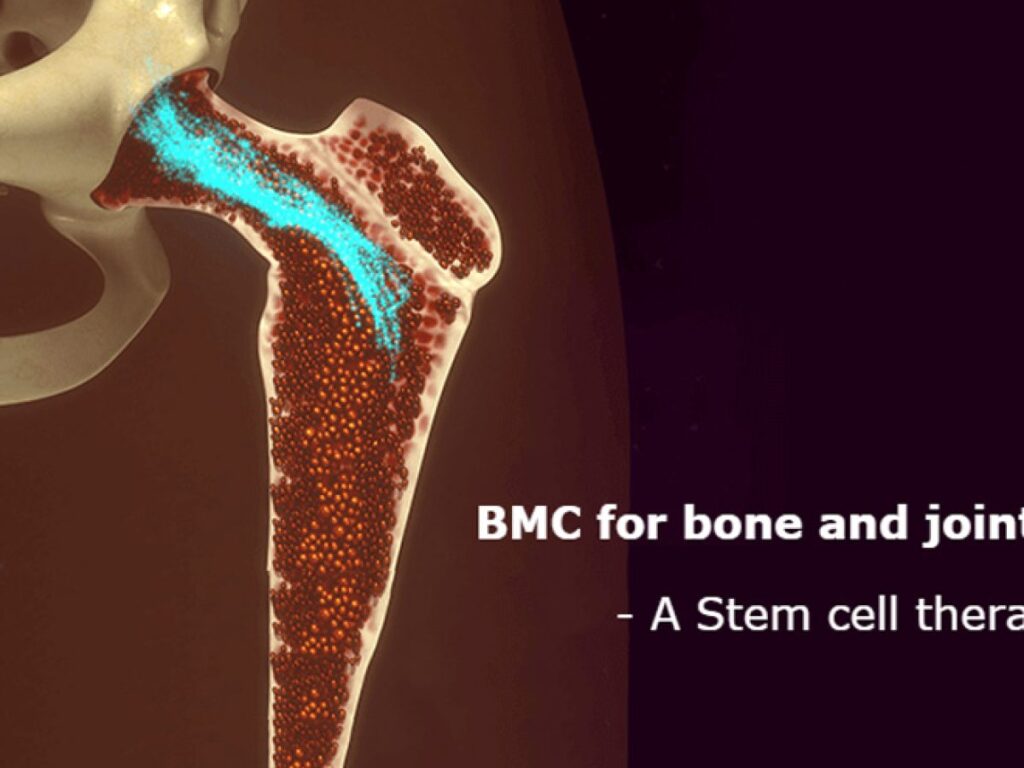 bone marrow concentrate bmc a regenerative therapy for bone and joint injuries 1 1200x900
