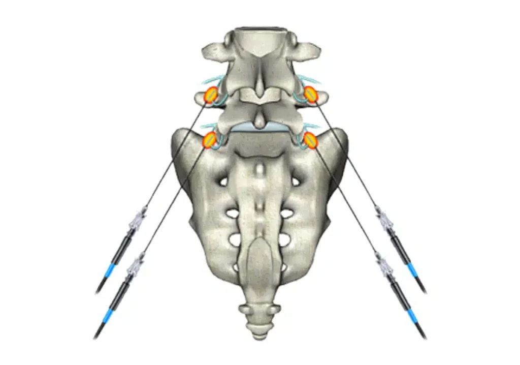 radiofrequency ablation